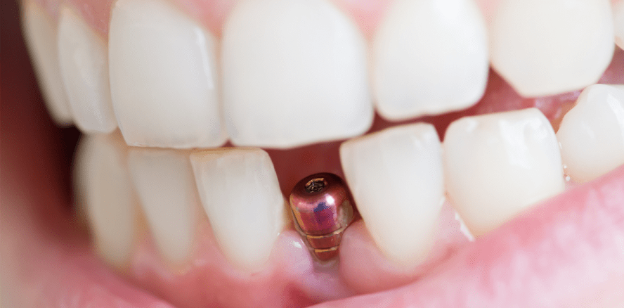 Wenn Zahnersatz Allergien auslöst – Was gilt es zu beachten?