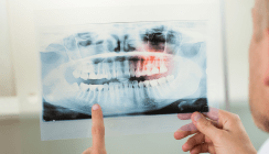 Allogene Knochenblockaugmentation bei Parodontitispatienten