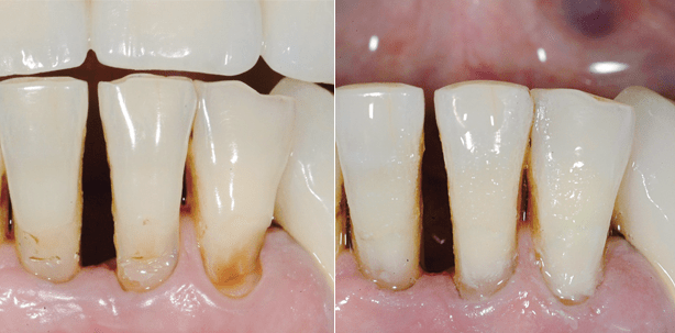 Altersbedingte (Risiko-)Faktoren bei der Füllungstherapie