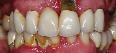 Perioprothetik als Schlüsselkonzept in der Zielgruppe 50+