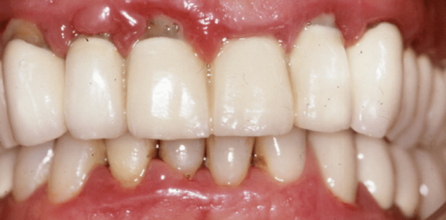 Alveoläre Knochenneubildung nach geschlossener Taschentherapie