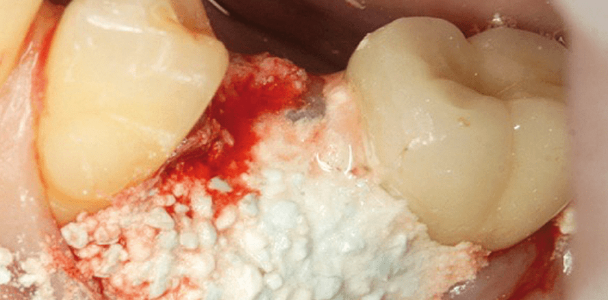 Alveolenmanagement mit Knochenzementen auf Calciumsulfat-Basis