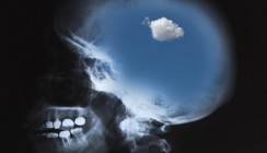 Alzheimer durch schlechte Zähne