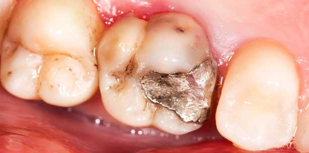 Wann ist eine Amalgam-Füllung auszutauschen?