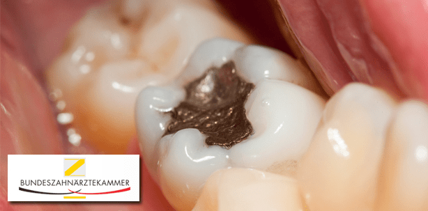 BZÄK gegen generelles Amalgamverbot