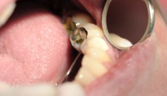 Was hält länger: Amalgam oder Glasionomer?