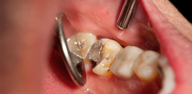 Amalgam muss erhalten bleiben