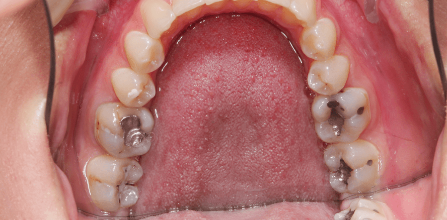 Amalgam: Immer noch weitverbreitet in Schweizer Mündern