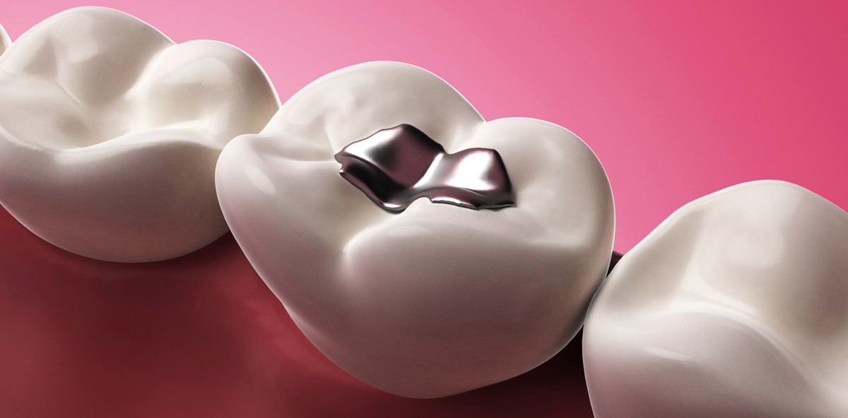 Amalgam erst ab acht Füllungen gefährlich?