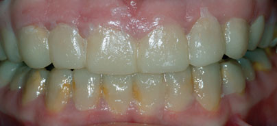 Minimal- und No Prep- Veneers bei Amelogenesis imperfecta