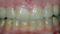 Minimal- und No Prep- Veneers bei Amelogenesis imperfecta