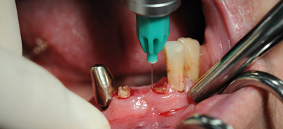 Intraligamentäre Anästhesie bei anatomisch eng begrenzten dentoalveolären Eingriffen