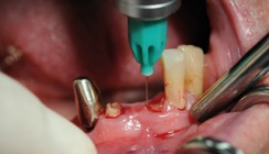 Intraligamentäre Anästhesie bei anatomisch eng begrenzten dentoalveolären Eingriffen