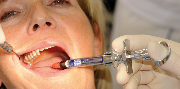 Phentolaminmesilat zur Verkürzung der Gewebeanästhesie