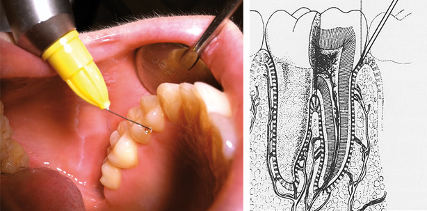 Minimalinvasive Lokalanästhesie – keine Aufklärungspflicht