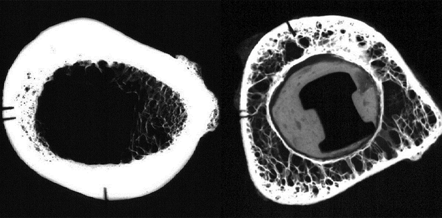 Periimplantitis: Analyse und Hinweise zur Implantatauswahl