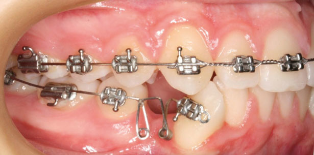 Die Steuerung kieferorthopädischer Zahnbewegung