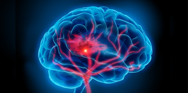 Verursachen Zahnbakterien Hirnaneurysmen?