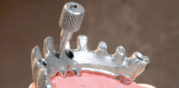 Angulierte Schraubenzugänge bei Implantat-Suprastrukturen