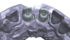 Ein komplexer Fall – gelöst mit CAD/CAM-Technologie
