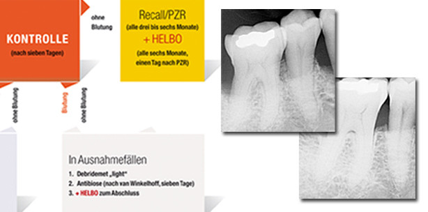Adjuvante minimalinvasive Parodontitis- und Periimplantitistherapie
