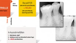Adjuvante minimalinvasive Parodontitis- und Periimplantitistherapie