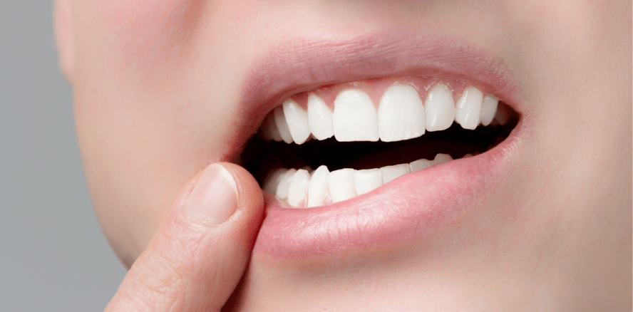 Aphthen: Wie man gegen die kleinen Bläschen im Mund vorgehen kann