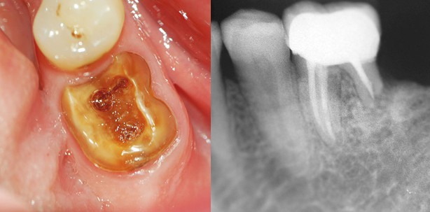 Apikale externe Resorption bei Risikopatienten