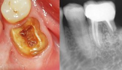 Apikale externe Resorption bei Risikopatienten