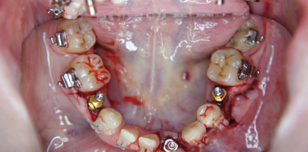 Multiple Aplasie von Zähnen im Ober- und Unterkiefer