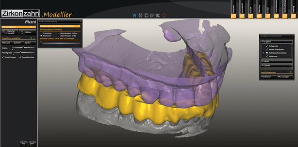 Apnoeschienen digital herstellen mittels CAD/CAM