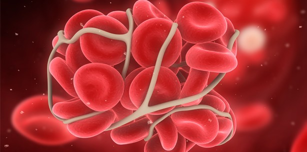 Gingivitis erhöht Risikofaktoren für Arteriosklerose
