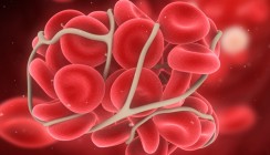 Gingivitis erhöht Risikofaktoren für Arteriosklerose