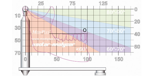 Die Artikulatorprogrammierung mit dem Vector-Analyzer