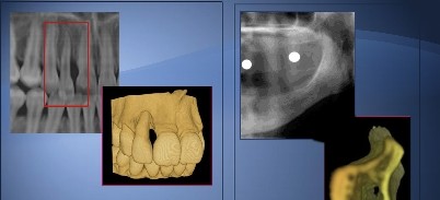 Präzise 3-D-Diagnostik und Implantatplanung