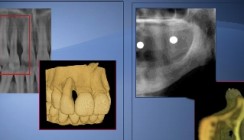 Präzise 3-D-Diagnostik und Implantatplanung