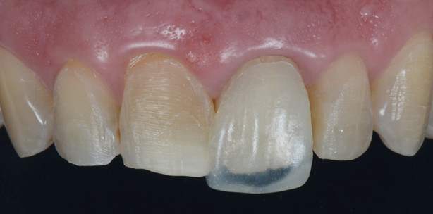 Verbesserte Ästhetik mit CAD/CAM-Verfahren