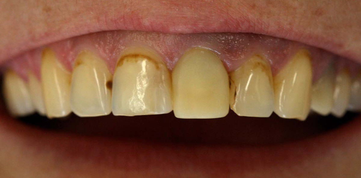 Ästhetik aus der Perspektive des Patienten … ist nicht immer unsere Ästhetik!