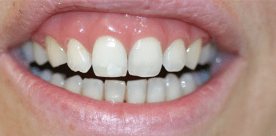 Parodontologie und Ästhetik – ein Widerspruch?