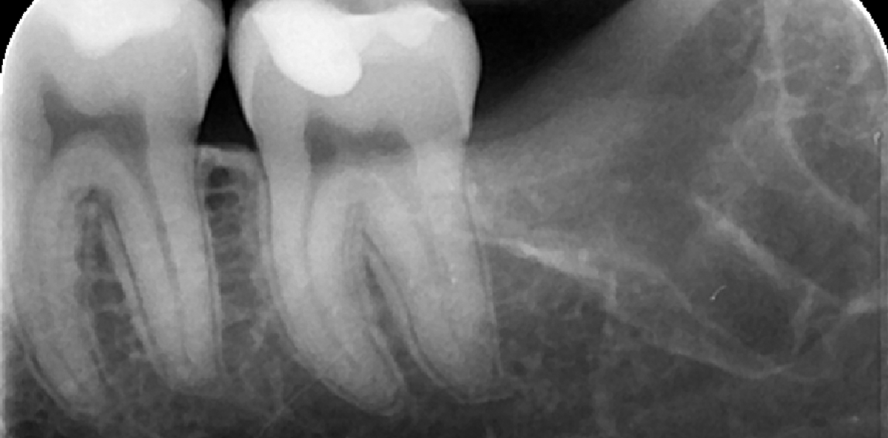 Atraumatische Extraktion der unteren Weisheitszähne