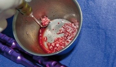 Maximale Sicherheit beim Sinuslift