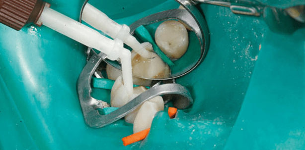 Multiple Verwendung von Aufbaukomposit