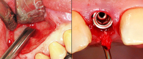 Natürliche Ästhetik durch Erhalt von Hart- und Weichgewebe