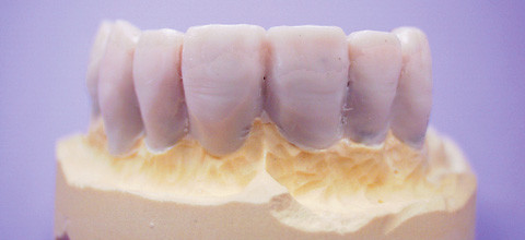 Kunststoffverblendungen - schnell und sicher