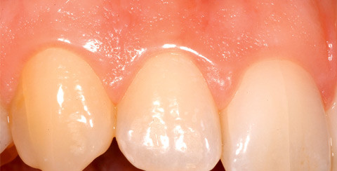 Wie viel Pflege braucht das Zahnfleisch?