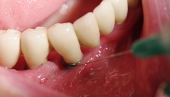 Periimplantäre ­Läsionen in der Alterszahnheilkunde