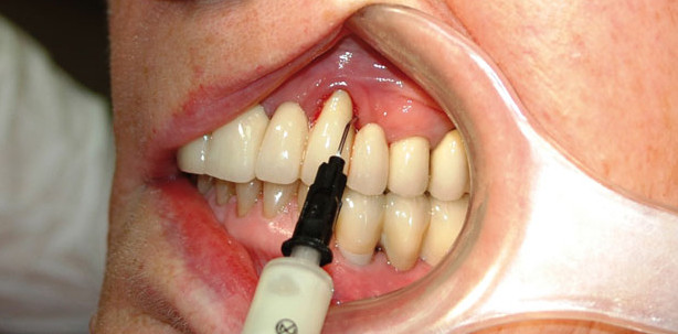 Bakterien – mit den „Guten“ gegen die „Bösen“