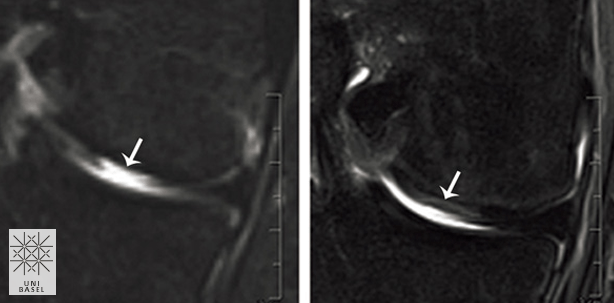 Von der Nase zum Knie: Gelenke mit körpereigenem Knorpel repariert