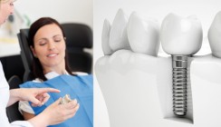 Prophylaxe der Periimplantitis – ein systematischer Überblick – Teil 2