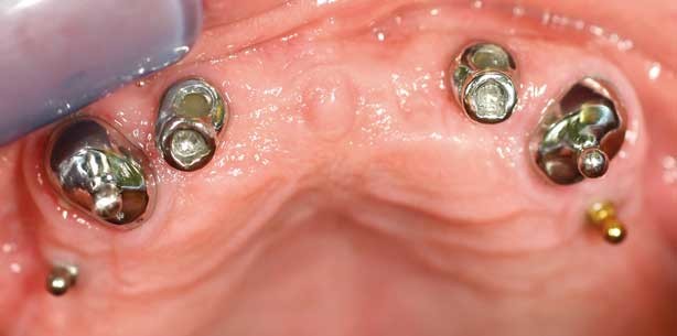 Mini-Implantate: Vielseitige Optionen zur Verankerung von Teilprothesen